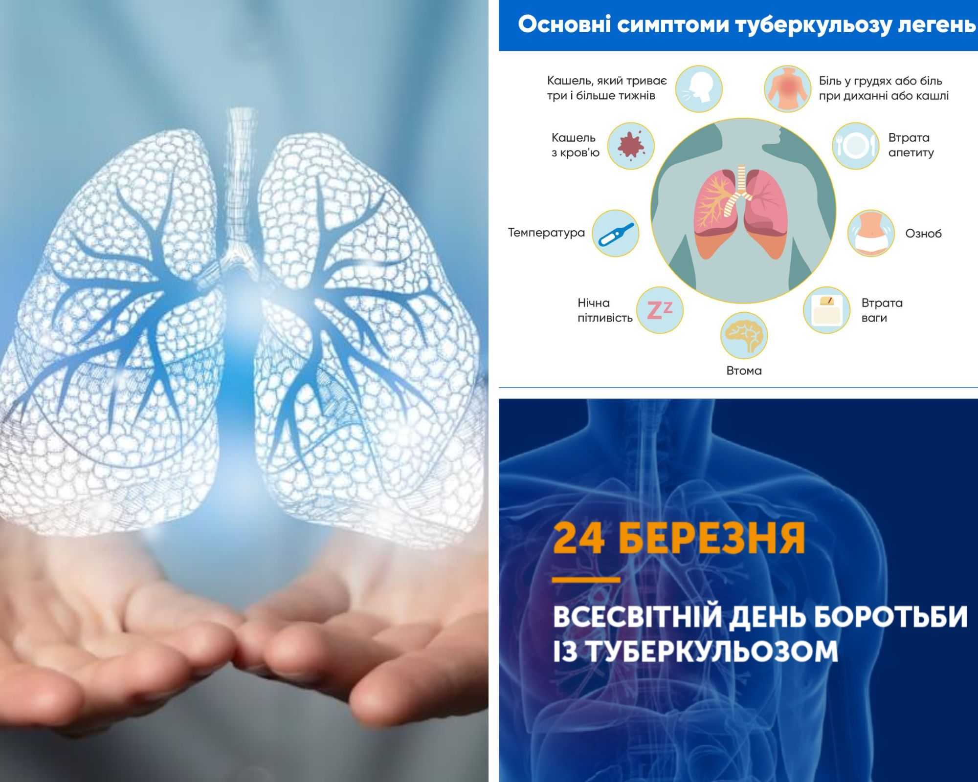 «ТАК! МИ МОЖЕМО ПОДОЛАТИ ТУБЕРКУЛЬОЗ!»